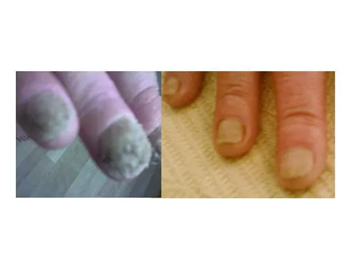 FungiFree™ Nail Rescue